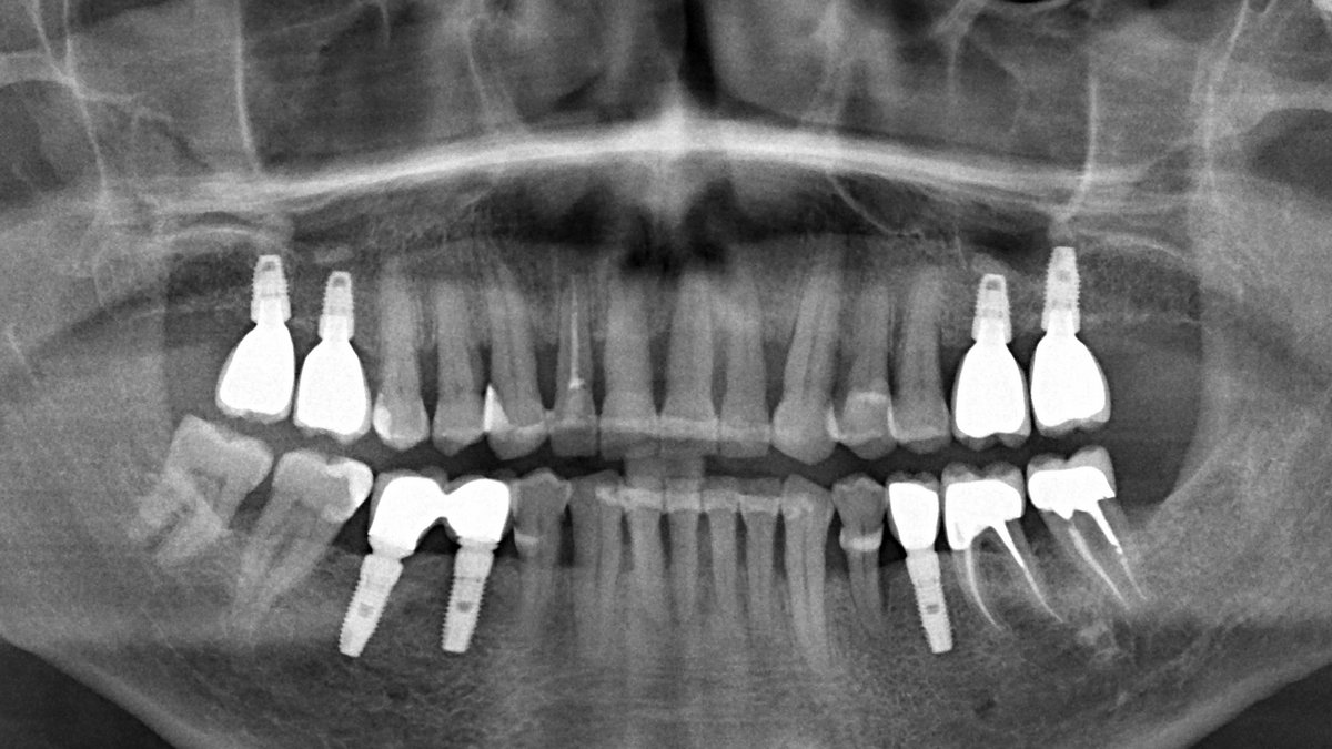 Имплант зуба калининград. Импланты в верхней челюсти снимок. Рентген зуба верхней челюсти. Импланты верхняя челюсть на ОПТГ. ROOTT имплантация.
